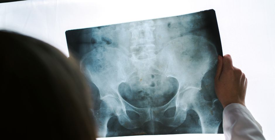 pinzamiento lumbar